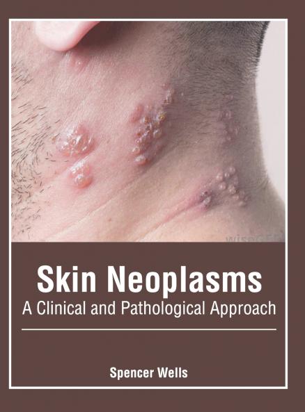 Skin Neoplasms