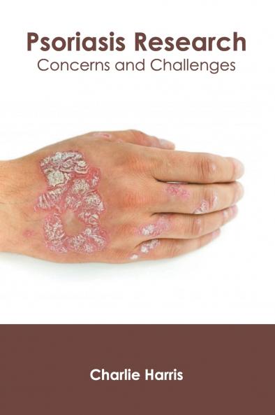 Psoriasis Research