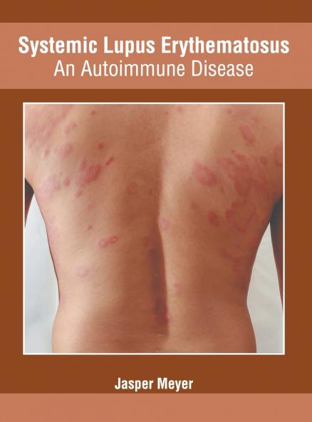 Systemic Lupus Erythematosus