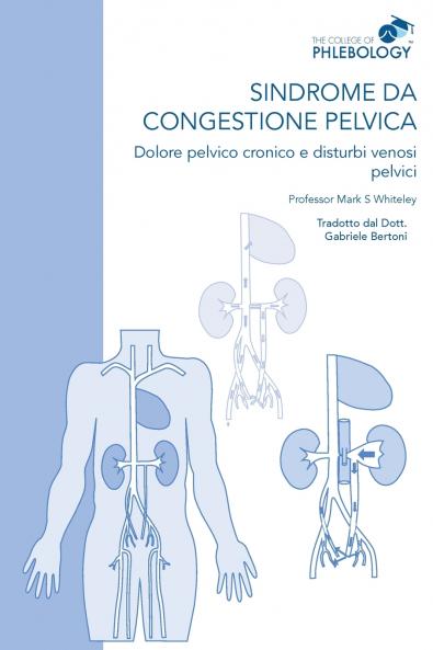 Sindrome da congestione pelvica - Dolore pelvico cronico e disturbi venosi pelvici