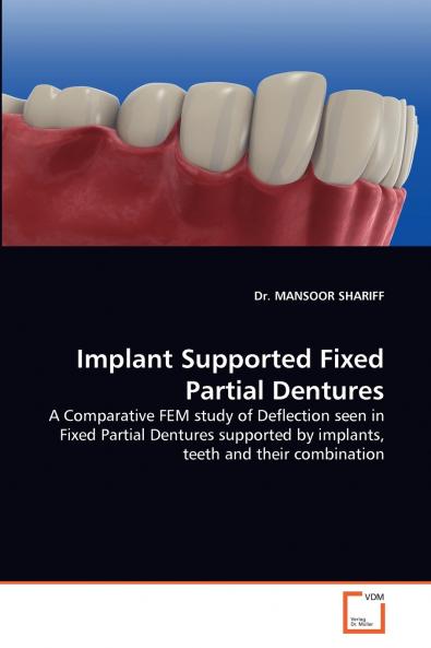 Implant Supported Fixed Partial Dentures