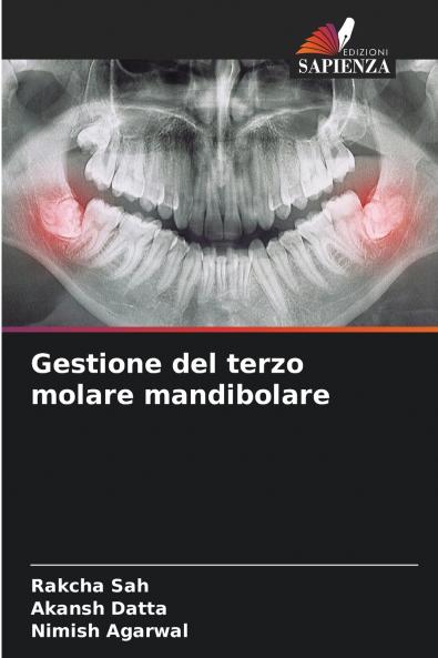 Gestione del terzo molare mandibolare