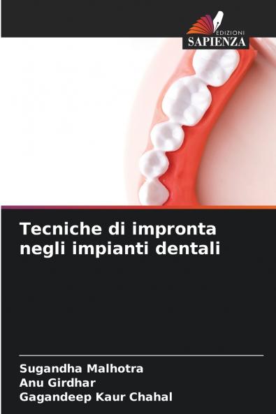 Tecniche di impronta negli impianti dentali