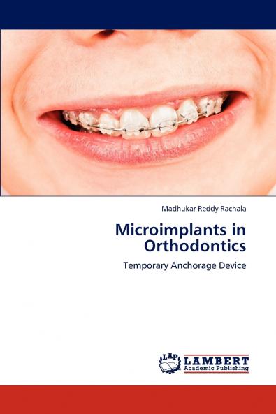 Microimplants in Orthodontics