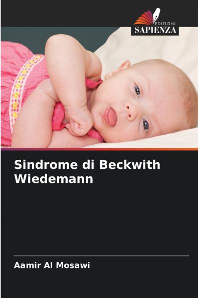 Sindrome di Beckwith Wiedemann
