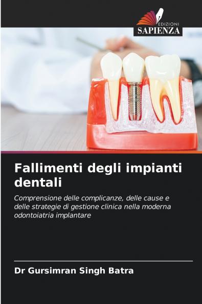 Fallimenti degli impianti dentali