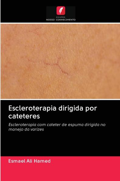 Escleroterapia dirigida por cateteres