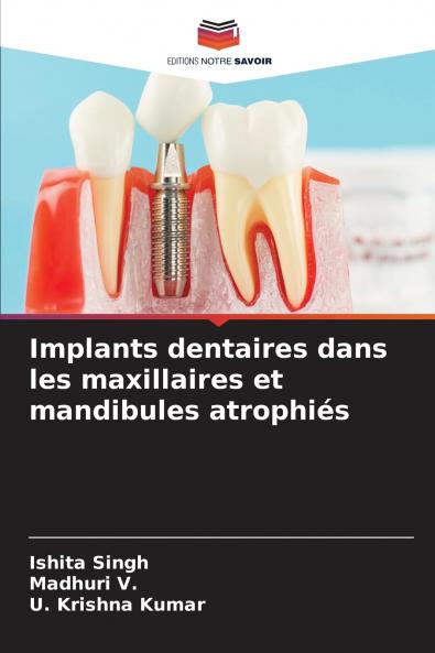 Implants dentaires dans les maxillaires et mandibules atrophiés