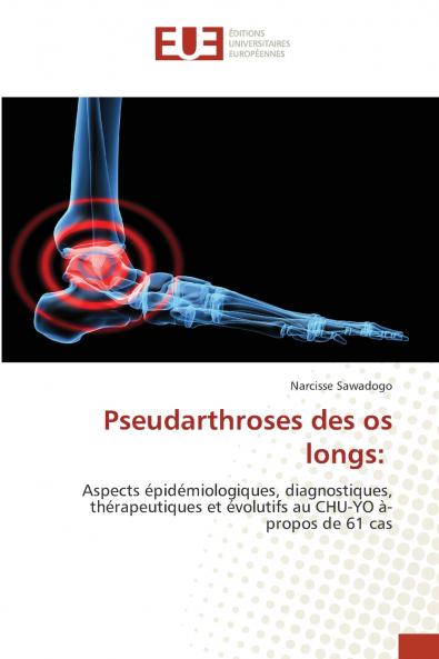 Pseudarthroses des os longs
