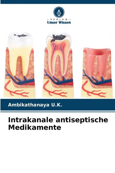 Intrakanale antiseptische Medikamente