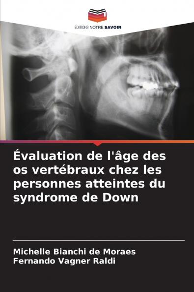 Évaluation de l'âge des os vertébraux chez les personnes atteintes du syndrome de Down
