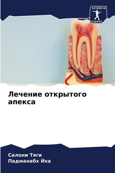 Лечение открытого апекса