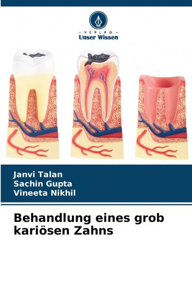 Behandlung eines grob kariösen Zahns