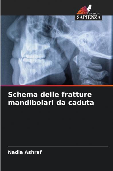 Schema delle fratture mandibolari da caduta