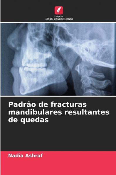 Padrão de fracturas mandibulares resultantes de quedas