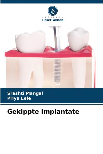 Gekippte Implantate