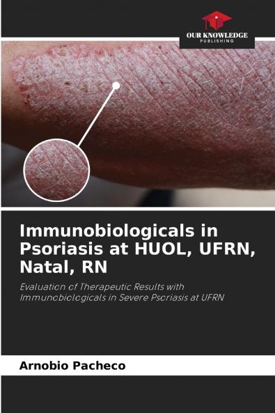 Immunobiologicals in Psoriasis at HUOL UFRN Natal RN