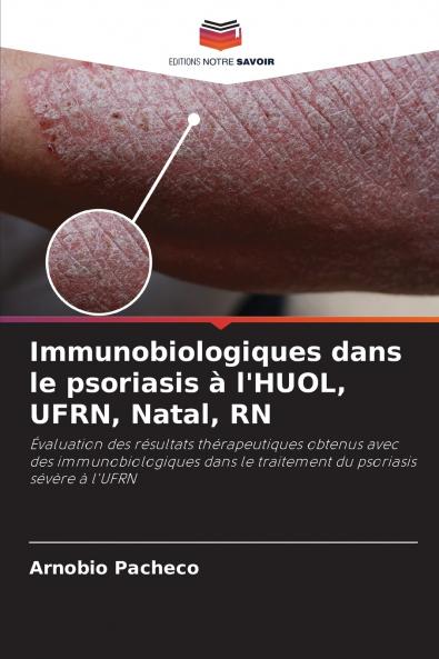 Immunobiologiques dans le psoriasis à l'HUOL UFRN Natal RN