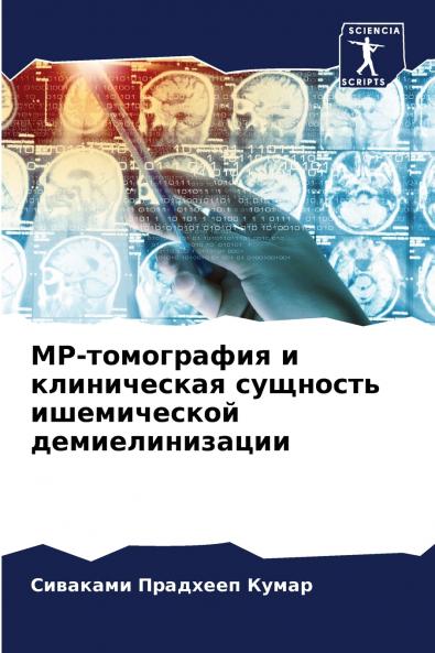 МР-томография и клиническая сущность ишемической демиелинизации