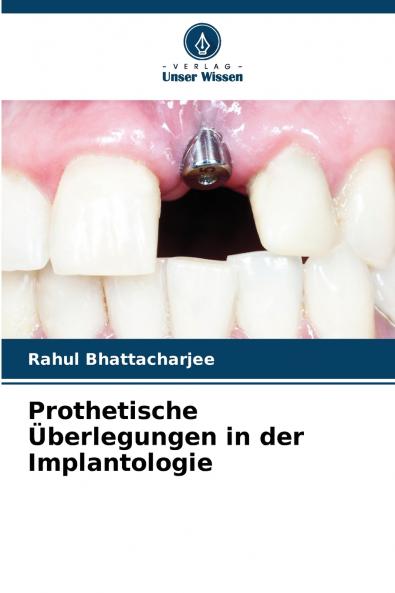 Prothetische Überlegungen in der Implantologie