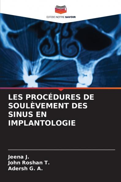 LES PROCÉDURES DE SOULÈVEMENT DES SINUS EN IMPLANTOLOGIE