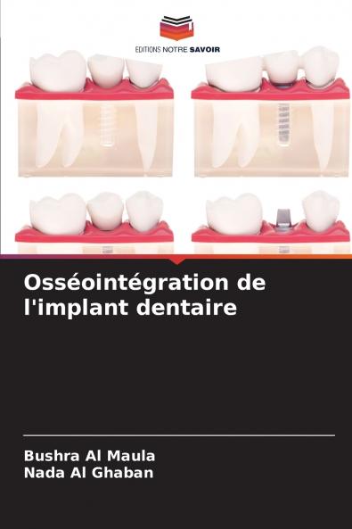 Osséointégration de l'implant dentaire
