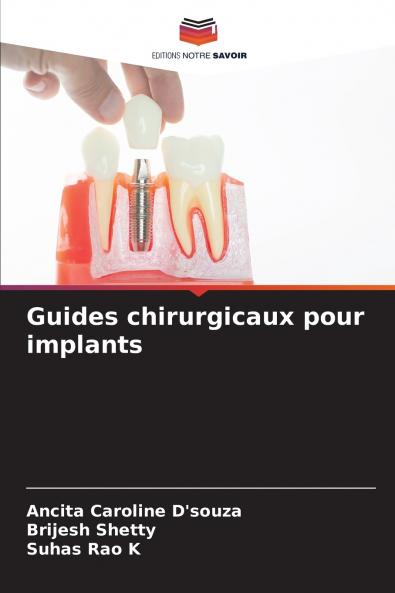 Guides chirurgicaux pour implants