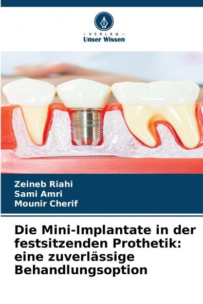 Die Mini-Implantate in der festsitzenden Prothetik