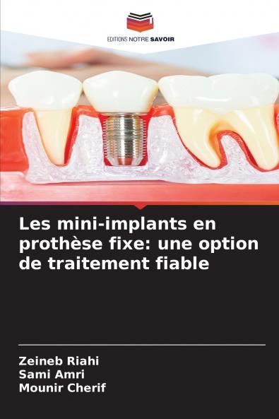 Les mini-implants en prothèse fixe