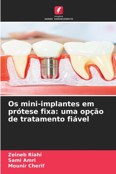 Os mini-implantes em prótese fixa