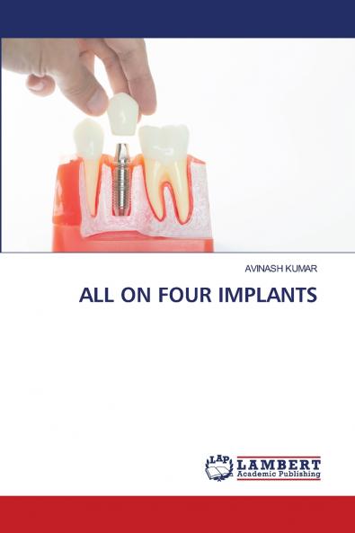 ALL ON FOUR IMPLANTS