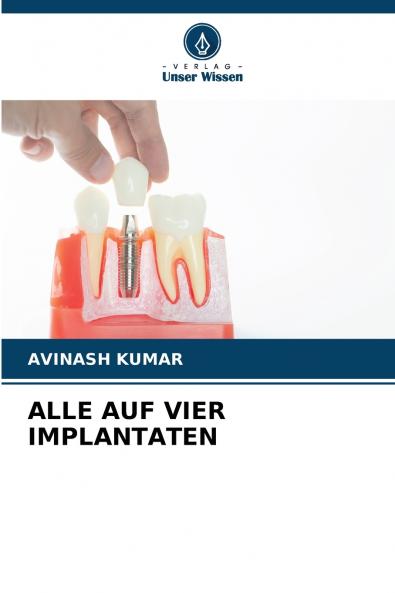 ALLE AUF VIER IMPLANTATEN