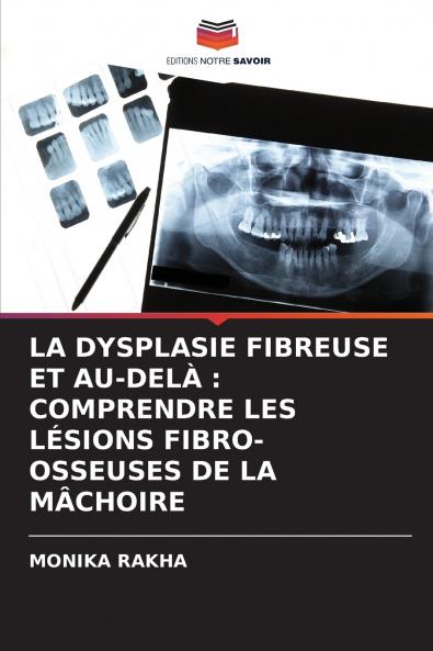 LA DYSPLASIE FIBREUSE ET AU-DELÀ