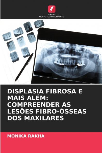 DISPLASIA FIBROSA E MAIS ALÉM