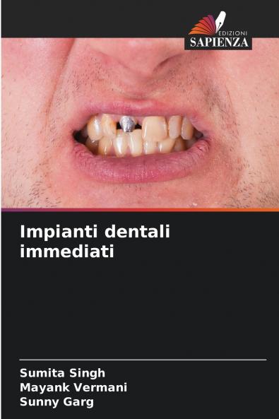 Impianti dentali immediati