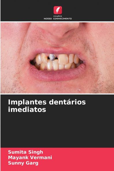Implantes dentários imediatos