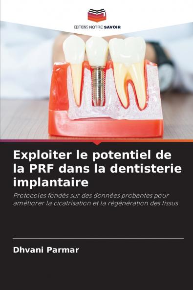 Exploiter le potentiel de la PRF dans la dentisterie implantaire