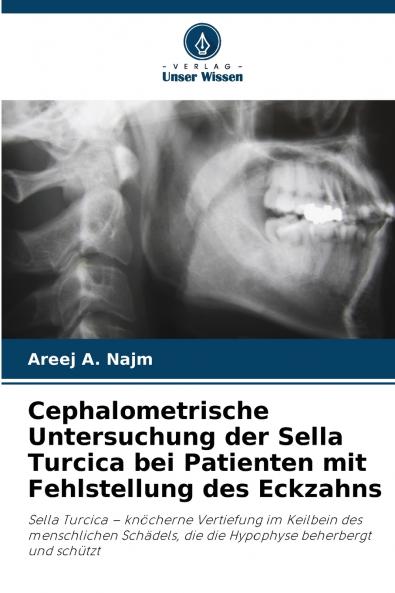 Cephalometrische Untersuchung der Sella Turcica bei Patienten mit Fehlstellung des Eckzahns