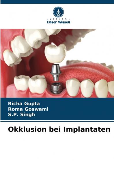 Okklusion bei Implantaten