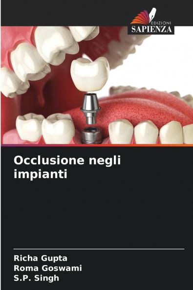 Occlusione negli impianti
