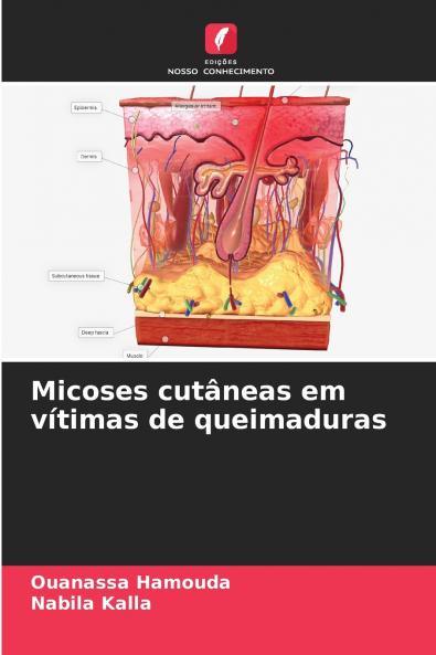 Micoses cutâneas em vítimas de queimaduras
