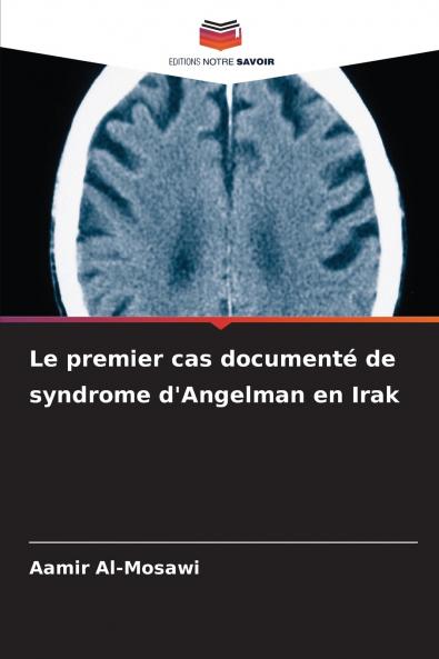 Le premier cas documenté de syndrome d'Angelman en Irak