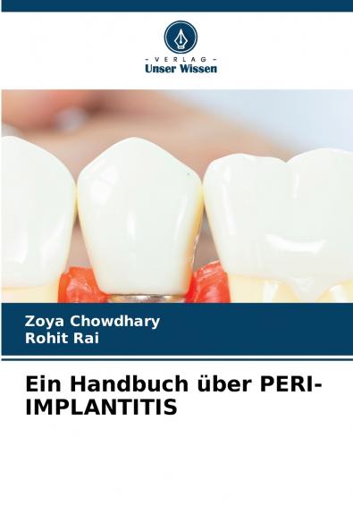 Ein Handbuch über PERI-IMPLANTITIS