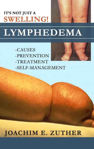 It's Not Just a Swelling! Lymphedema