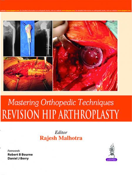 MASTERING ORTHOPEDIC TECHNIQUES REVISION HIP ARTHROPLASTY