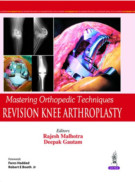Mastering Orthopedic Techniques REVISION KNEE ARTHROPLASTY