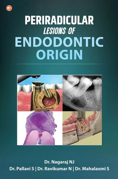 Periradicular lesions of Endodontic origin