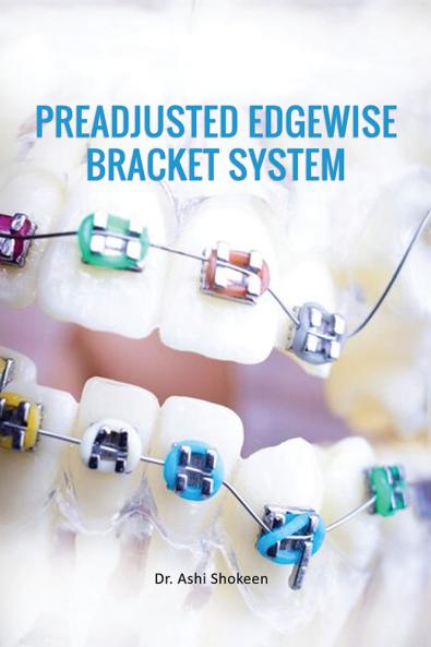 Preadjusted Edgewise Bracket System