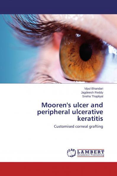 Mooren's ulcer and peripheral ulcerative keratitis