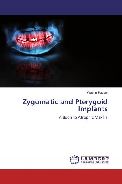 Zygomatic and Pterygoid Implants